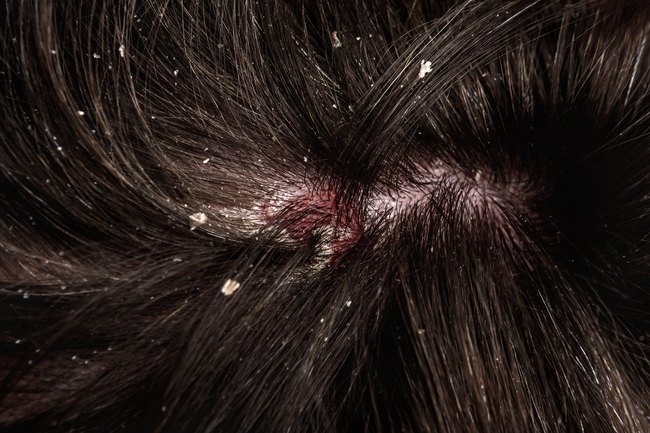 The Complete Dandruff Guide