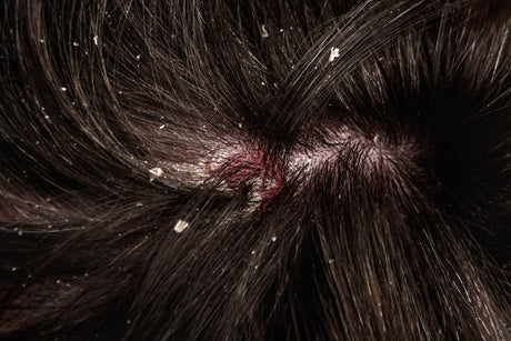 The Complete Dandruff Guide